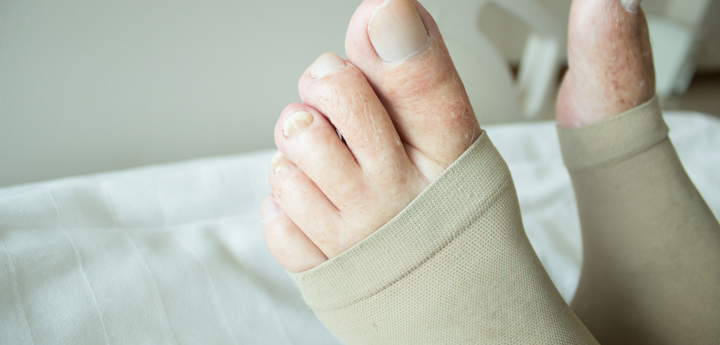 Close up of toes with compression stockings